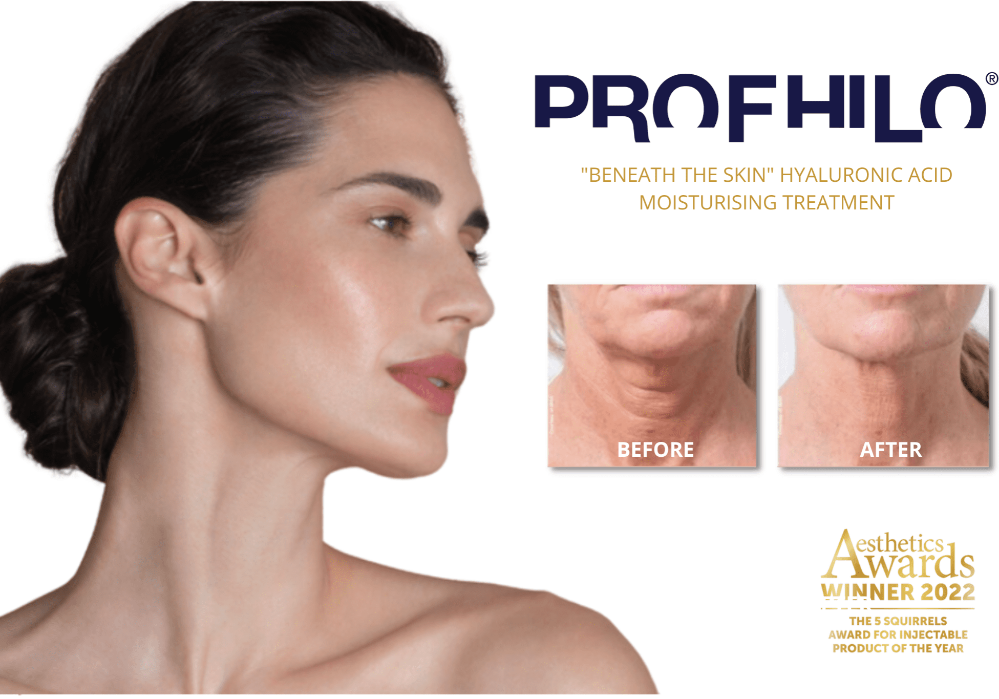 Profhilo Hyaluronic Acid Moisturising Treatment before and after